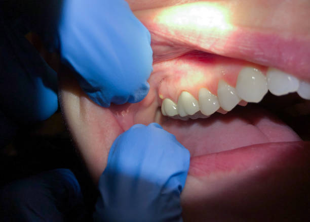 Best Emergency Treatment for Oral Infections in Manhattan Beach, CA