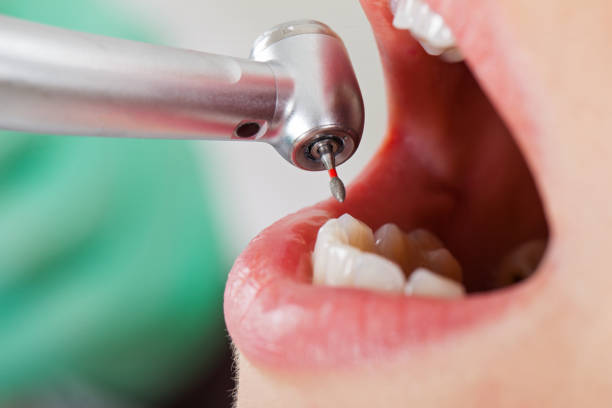 Best Dental Abscess Treatment in Manhattan Beach, CA